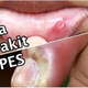 Illustration for article titled Obat herpes paling manjur di apotikem/em
